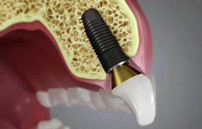 5 Reasons to Consider Cosmetic Dental Implants