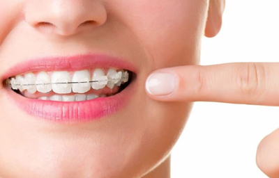 5 Things To Know Before Getting Braces In 2020 | Pasadena, CA