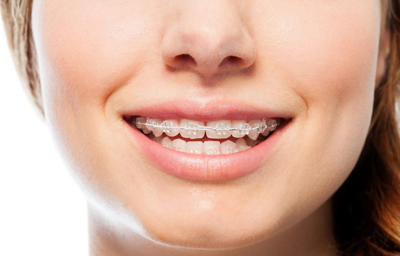 How Long Does Orthodontic Treatment Take? | Pasadena, CA