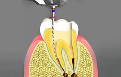 Root Canal Symptoms: 5 Ways to Tell If You Need a Root Canal | Pasadena CA