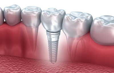 Why Choose a Dental Implant