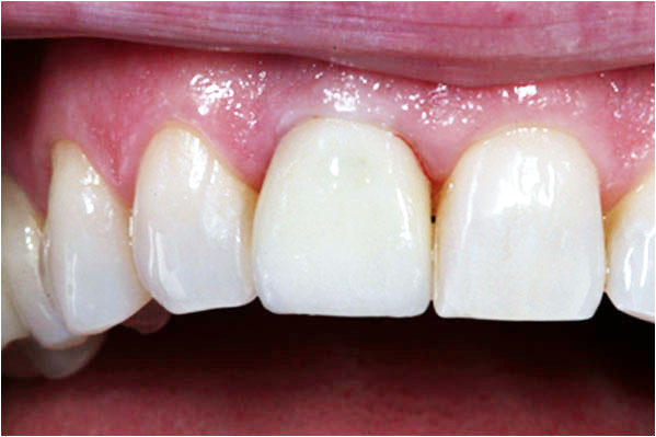 Dental Implants After 