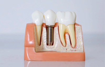 5 Myths and Misconceptions of Dental Implants | Pasadena