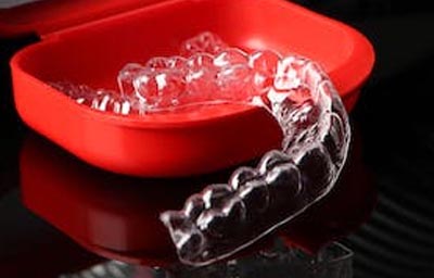 8 Tips You Need to Know About Invisalign | Pasadena