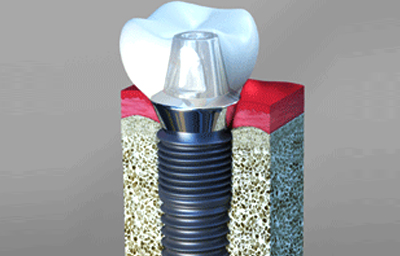 A Complete Guide to Dental Implants | Pasadena, CA