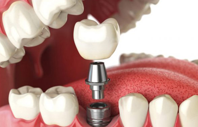 Are dental implants right for me? 