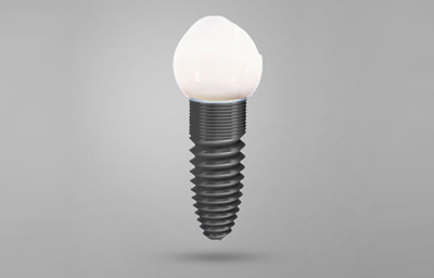 Are Dental Implants Safe in the Long Run? | Pasadena, CA