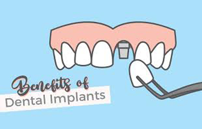 Benefits Of Dental Implants