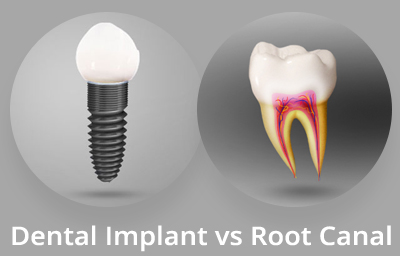 Dental Implant vs Root Canal: What to Consider