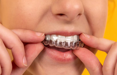 Do Root Canals Affect Invisalign?