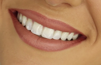 Does Teeth whitening really work?