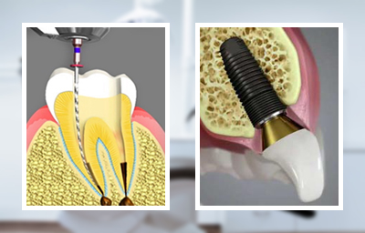 Making the Decision: Root Canal Vs Dental Implant