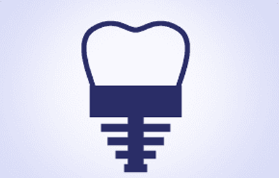 Same-Day Implants: How It Is Possible | Pasadena Same-Day Implants: How It Is Possible | Pasadena