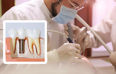 What Are the Different Types of Dental Implants? | Pasadena