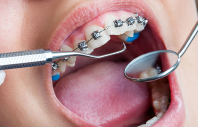 Dental Implants Periodontist In Garland