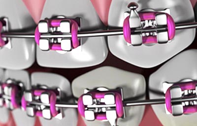 Why choose an orthodontic specialist over a general dentist? | Pasadena
