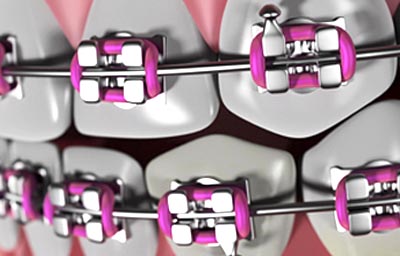 Why choose an orthodontic specialist over a general dentist? | Pasadena Why choose an orthodontic specialist over a general dentist? | Pasadena
