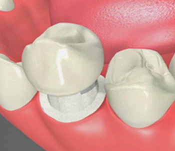 Dental Crowns Pasadena