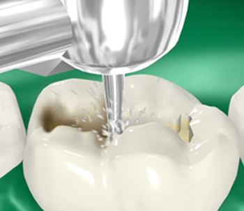 Dental Fillings Pasadena Dental Fillings Pasadena