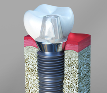 Dental Implants Pasadena Califonia