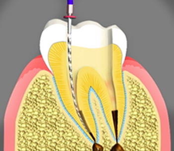 Endodontist/Root Canals in Pasadena, California