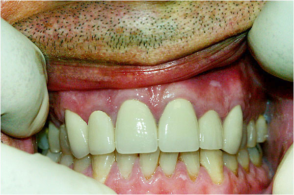 Dental Crowns After 