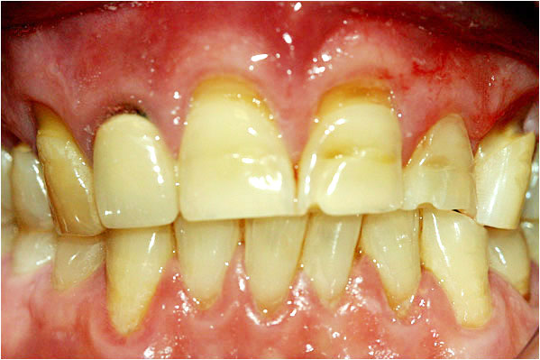 Dental Crowns Before