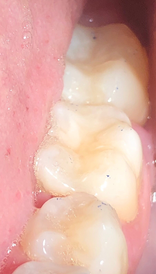 Invisalign After