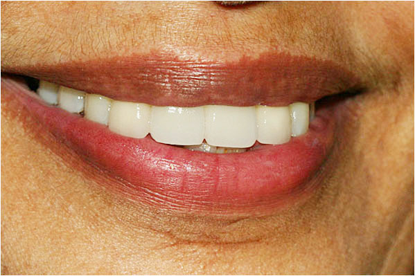 Dental Implants After