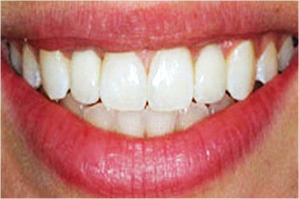 Dental Implants After 