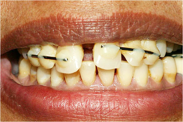 Dental Implants Before