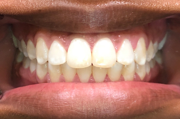 Invisalign After