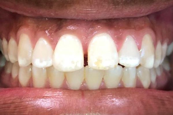 Invisalign Before