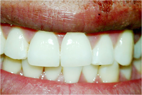 Dental Crowns After 