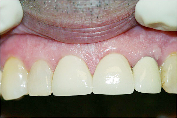 Dental Crowns After