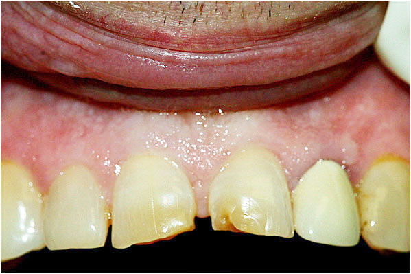 Dental Crowns Before 