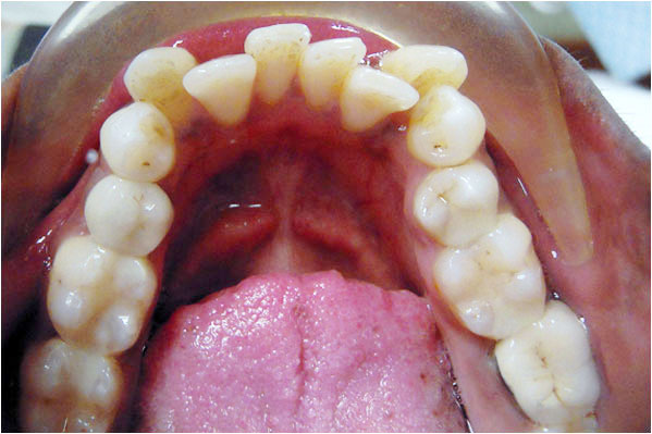 Orthodontics Before 