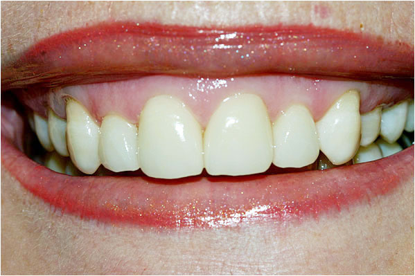 Veneers After