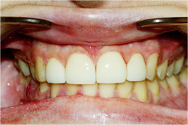 Veneers After 